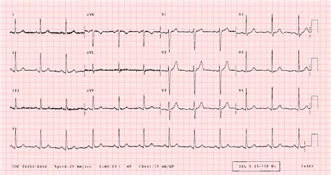 normal ecg 12 lead|ECGlibrary.com: Normal adult 12.
